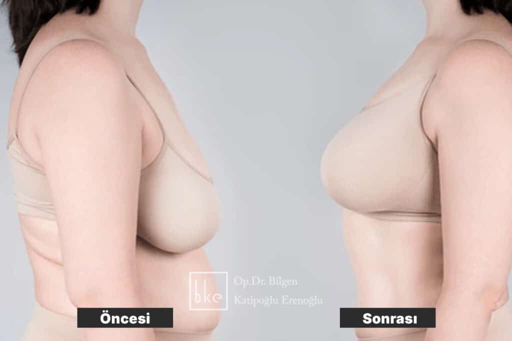Ameliyat Öncesi ve Sonrası Değişimler (Before & After)