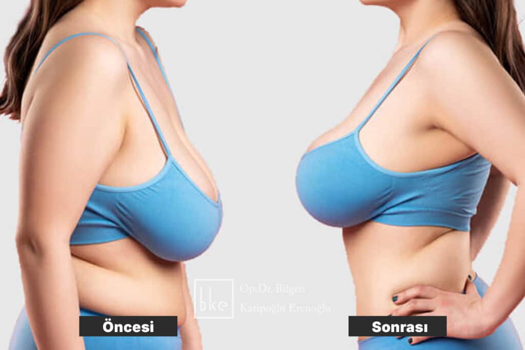 Ameliyat Öncesi ve Sonrası Değişimler (Before & After)