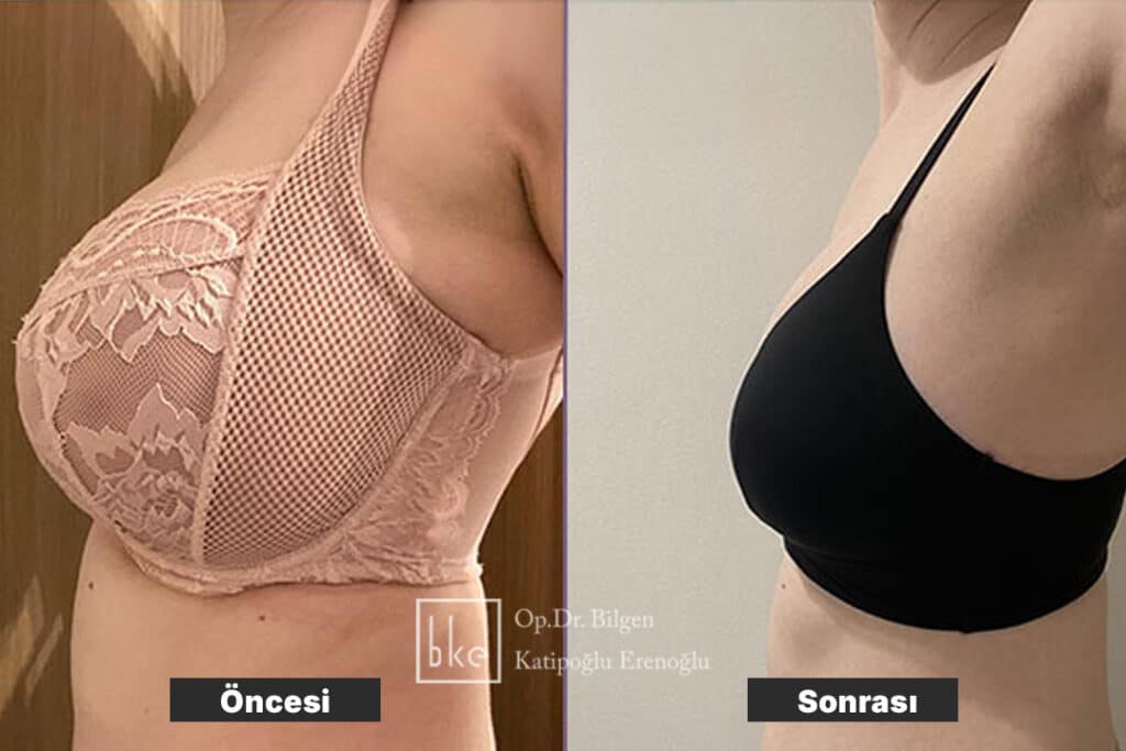 Ameliyat Öncesi ve Sonrası Değişimler (Before & After)