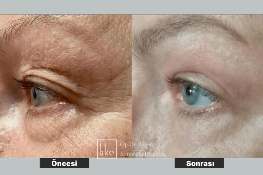 Ameliyatsız Tedavi Öncesi Sonrası Değişimler (Before & After)