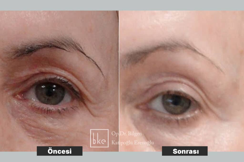 Ameliyatsız Tedavi Öncesi Sonrası Değişimler (Before & After)