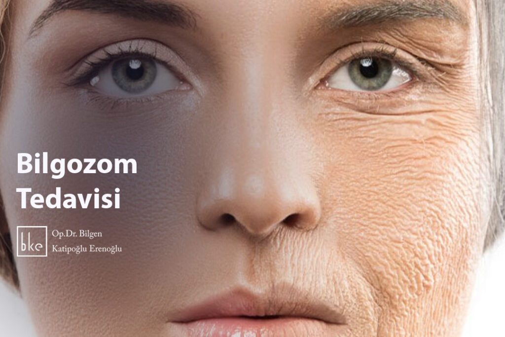 Bilgozom Tedavisi
