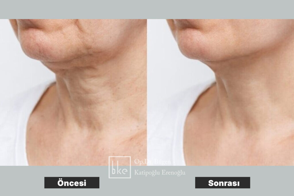 Bilgozom Tedavisi Öncesi ve Sonrası Fotoğraflar (Before & After)