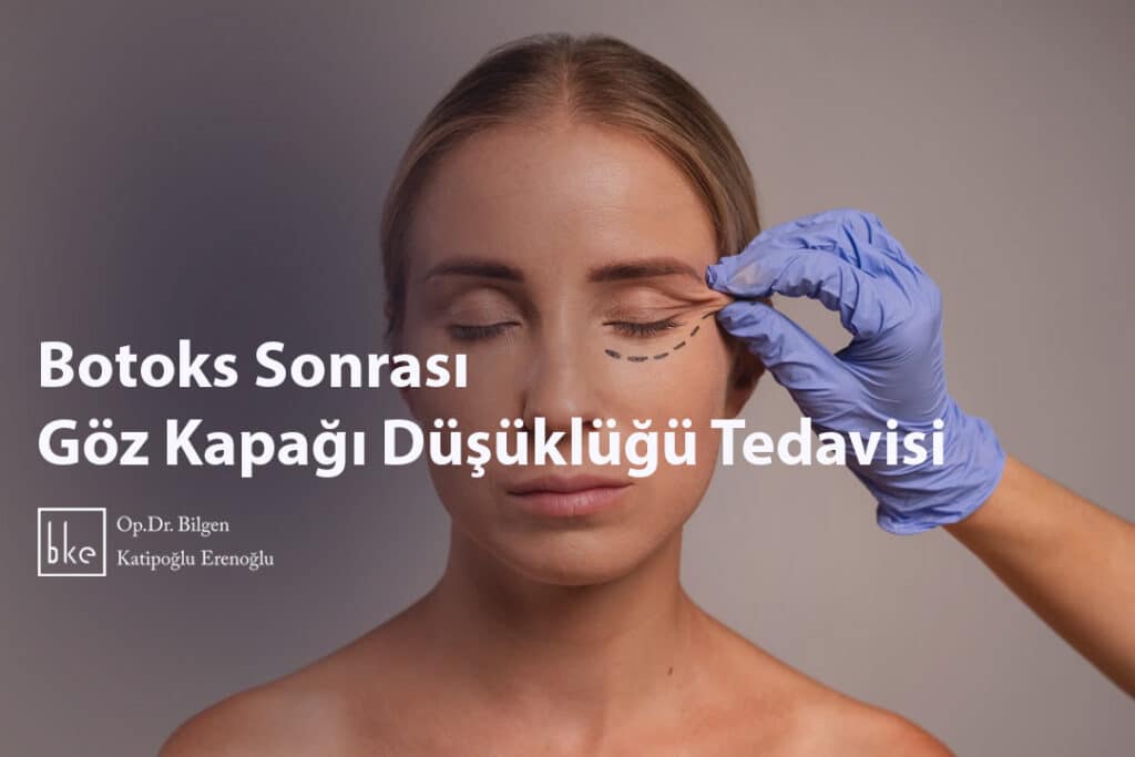 Botoks Sonrası Göz Kapağı Düşüklüğü Tedavisi