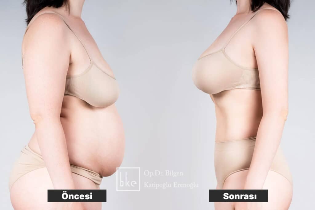 Memeye Yağ Enjeksiyonu Öncesi ve Sonrası Değişimler