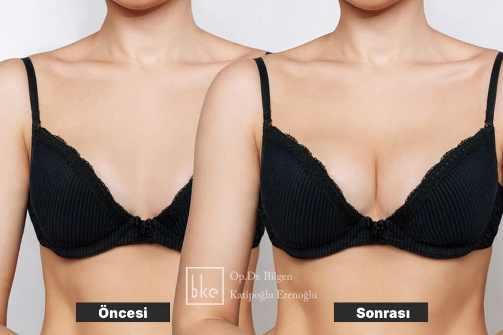 Memeye Yağ Enjeksiyonu Öncesi ve Sonrası Değişimler