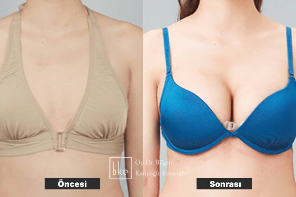 Memeye Yağ Enjeksiyonu Öncesi ve Sonrası Değişimler