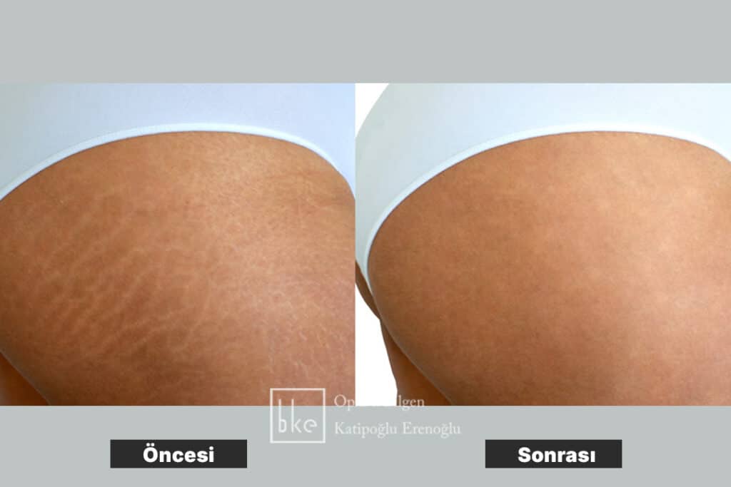 Çatlak Tedavisi Öncesi Sonrası Değişimler (Before & After)