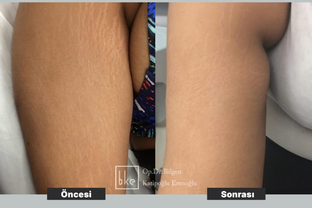 Çatlak Tedavisi Öncesi Sonrası Değişimler (Before & After)