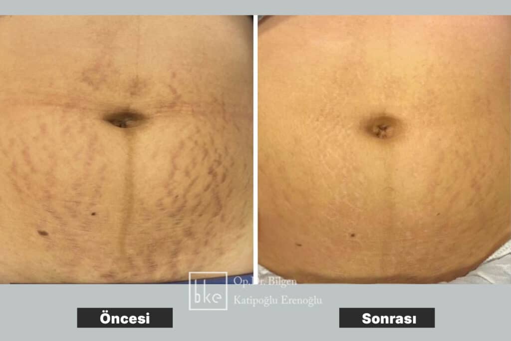 Çatlak Tedavisi Öncesi Sonrası Değişimler (Before & After)