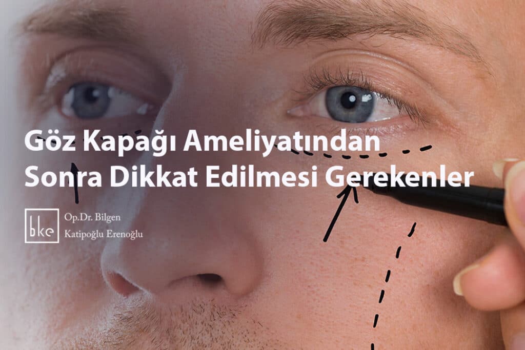 Göz Kapağı Ameliyatından Sonra Dikkat Edilmesi Gerekenler