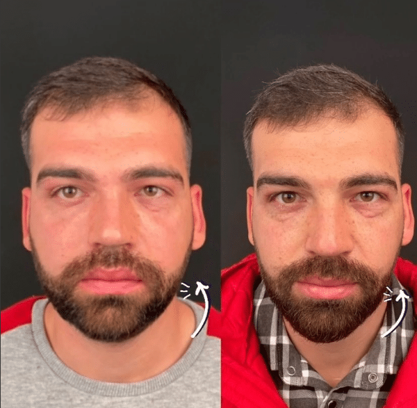 Bişektomi Öncesi Sonrası