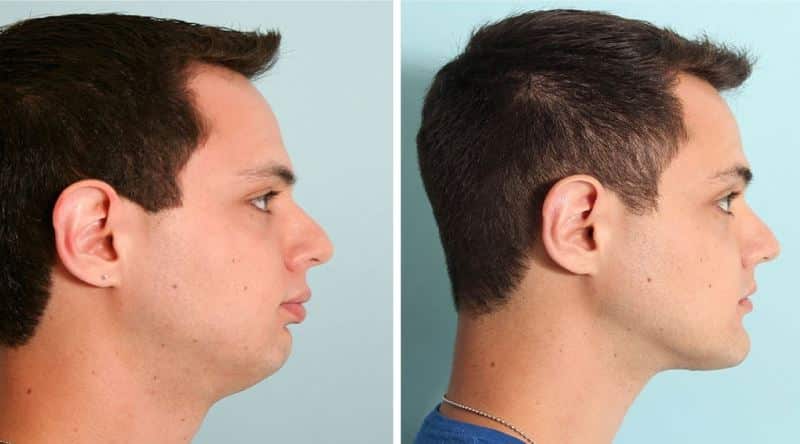 Jawline öncesi sonrası