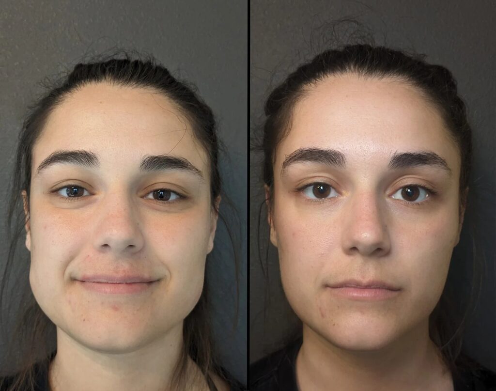 Masseter Botoksu Öncesi Sonrası