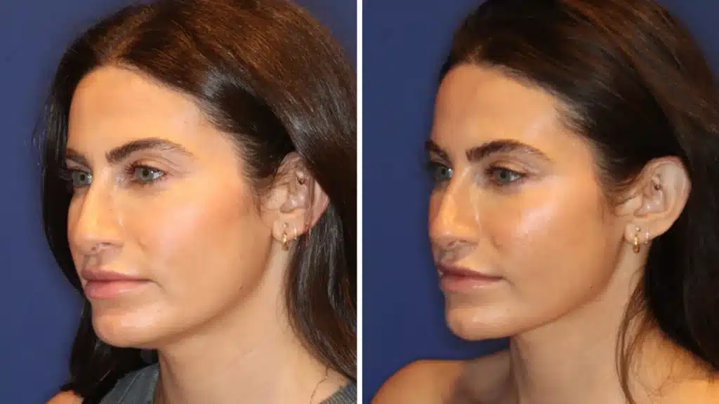 Nefertiti Lift