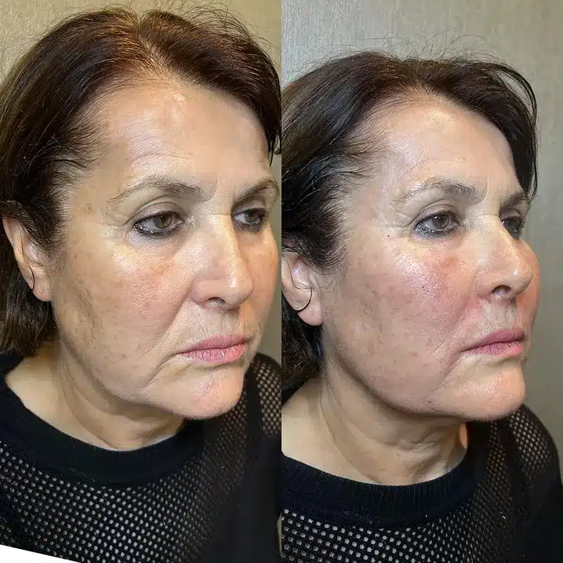 Sıvı Yüz Germe Öncesi Sonrası